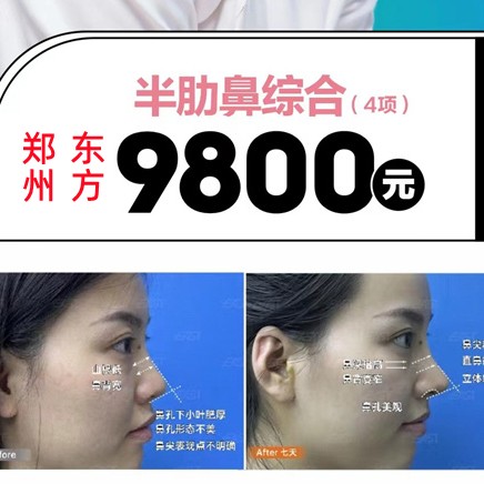 鄭州東方整形鼻子多少錢(qián)？李冰肋骨鼻9800起雙專(zhuān)利技術(shù)更自然