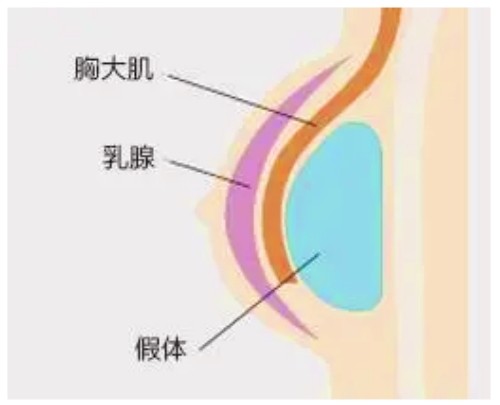 米蘭柏羽開(kāi)啟胸部醫(yī)生面診日，穆大力、李英大親診做出精致自然美胸