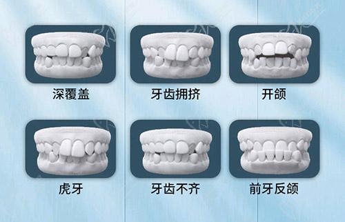 牙齒矯正適用人群