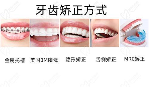 牙齒矯正方式