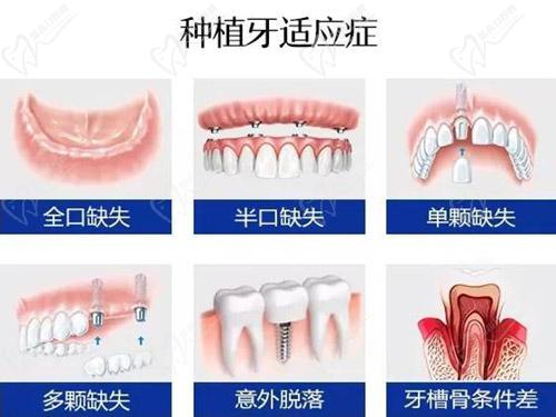 種植牙適應(yīng)癥