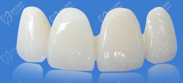 冰瓷牙和全瓷牙哪一個(gè)更好？看完冰瓷牙和全瓷牙的區(qū)別就明了