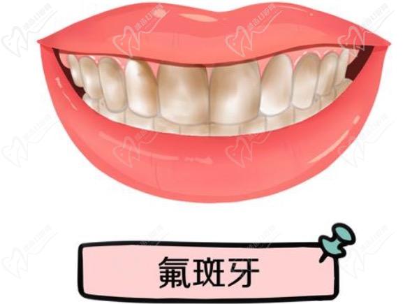 氟斑牙是什么原因造成的？