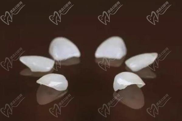 牙齒貼面多久可以做好？