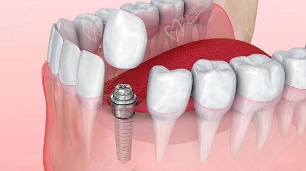 韓國登騰種植牙質(zhì)量好使用壽命長