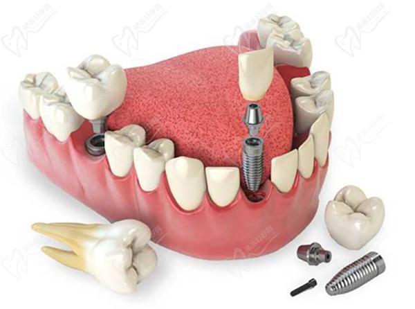 西安種植牙多少錢一顆2023年
