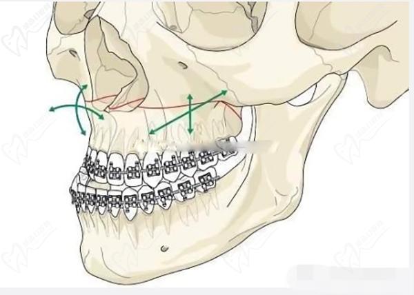 西安正頜手術(shù)蕞好的醫(yī)院醫(yī)生
