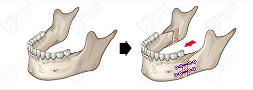 西安正頜手術(shù)蕞好的醫(yī)院醫(yī)生