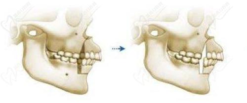 西安正頜手術(shù)費用一般是多少錢