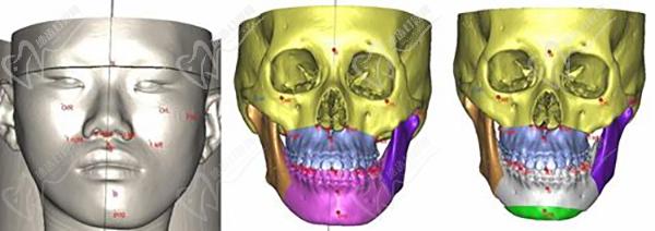 西安正頜手術(shù)能報銷嗎？