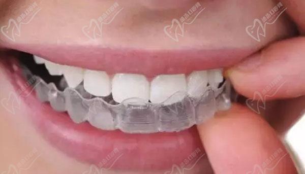 時代天使隱形矯正優(yōu)勢有什么