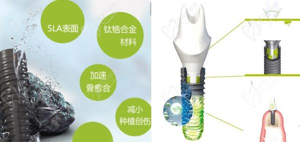 重慶齒齒美口腔醫(yī)院種植牙多少錢