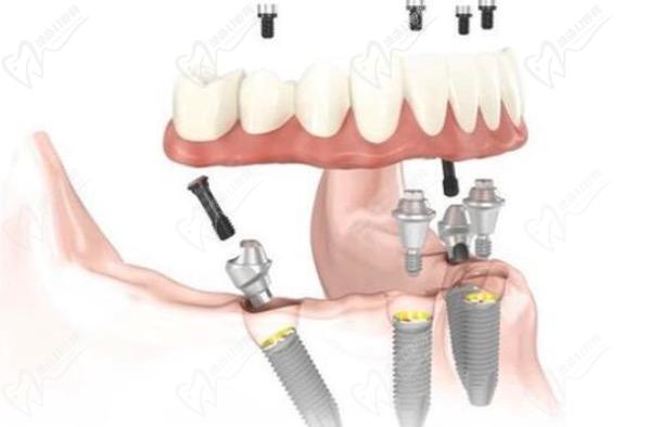 重慶齒齒美口腔醫(yī)院種植牙多少錢