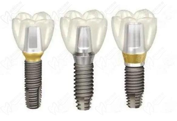 重慶齒齒美口腔醫(yī)院種植牙多少錢