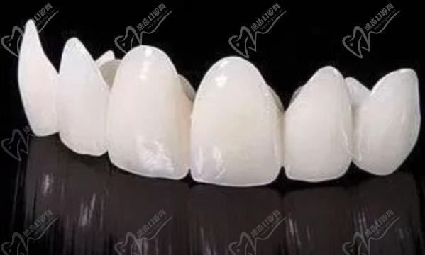 請(qǐng)問(wèn)牙齒貼面跟全瓷冠的區(qū)別有哪些？