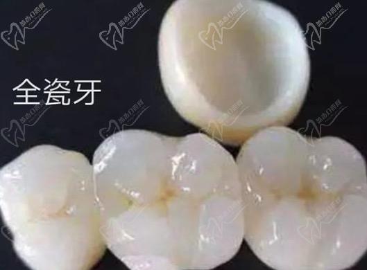 請(qǐng)問(wèn)牙齒貼面跟全瓷冠的區(qū)別有哪些？