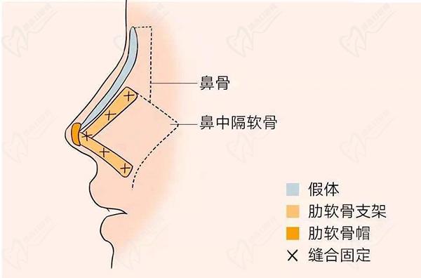 米蘭柏羽隆鼻哪個醫(yī)生好