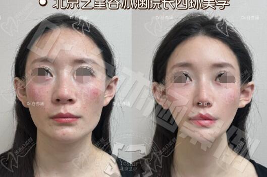 谷亦涵注射技術(shù)怎么樣？四環(huán)美學(xué)設(shè)計(jì)