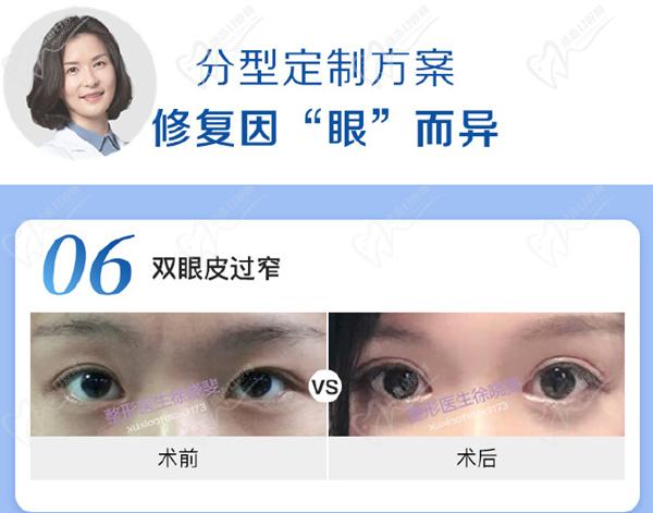 徐曉斐雙眼皮修復的怎么樣