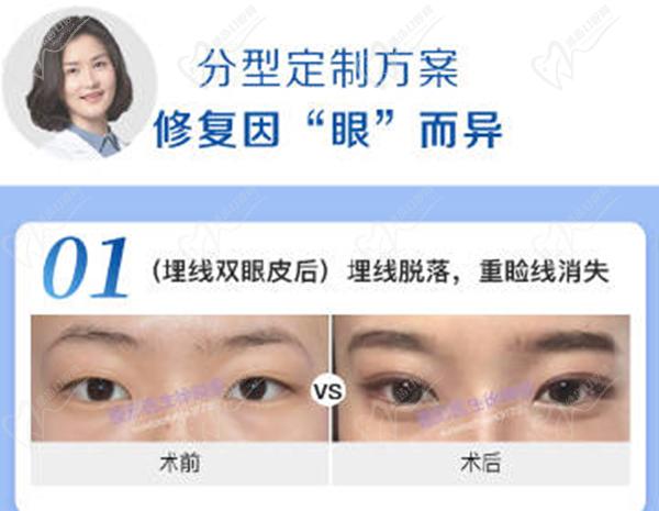 徐曉斐雙眼皮修復的怎么樣