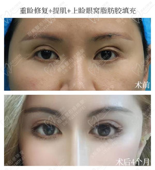 徐曉斐雙眼皮修復的怎么樣
