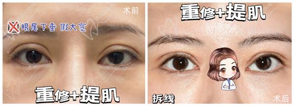 徐曉斐雙眼皮修復的怎么樣