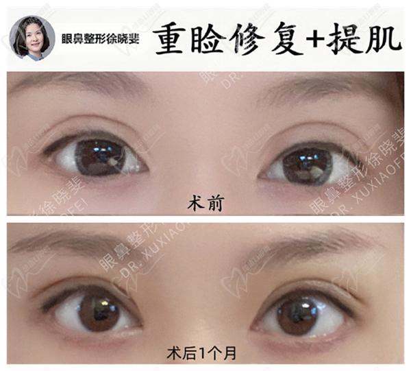 徐曉斐雙眼皮修復的怎么樣