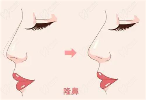 徐利剛做鼻子怎么樣？