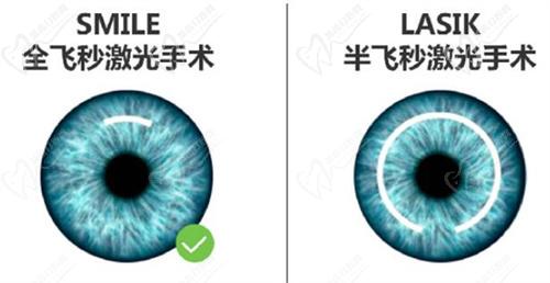 昆明近視手術(shù)哪家醫(yī)院好？