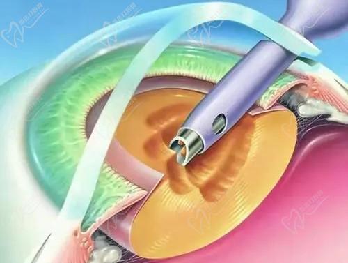 尹海泉做近視手術(shù)如何