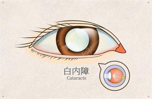 青海省人民 醫(yī)院眼科李凌白內(nèi)障手術(shù)多少例
