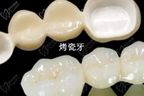 各地區(qū)牙齒貼面多少錢？2025價格表：