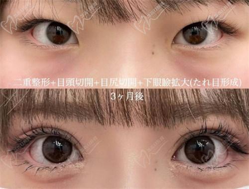 北京豐聯(lián)麗格醫(yī)療美容師麗麗修復(fù)雙眼皮怎么樣？