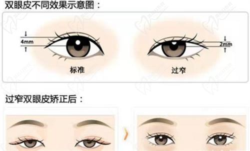 六、北京豐聯(lián)麗格整形醫(yī)院師麗麗醫(yī)生雙眼皮手術(shù)預(yù)約掛號方式