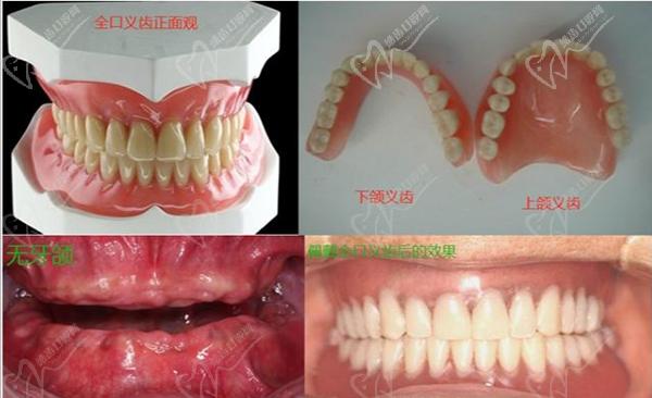 活動假牙的種類及價(jià)格