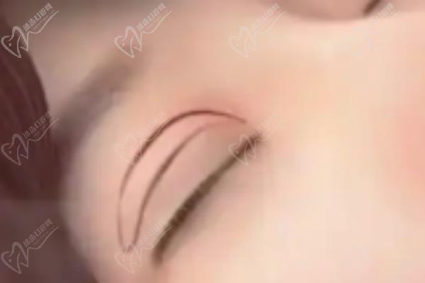 師麗麗雙眼皮修復(fù)手術(shù)項目優(yōu)勢分析