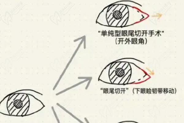 北京三仁伊光醫(yī)生雙眼皮切的怎么樣
