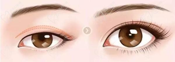 上海杜園園做眼睛失敗修復(fù)病例眾多，技術(shù)靠譜案例多，高難度眼修復(fù)難題不在話下